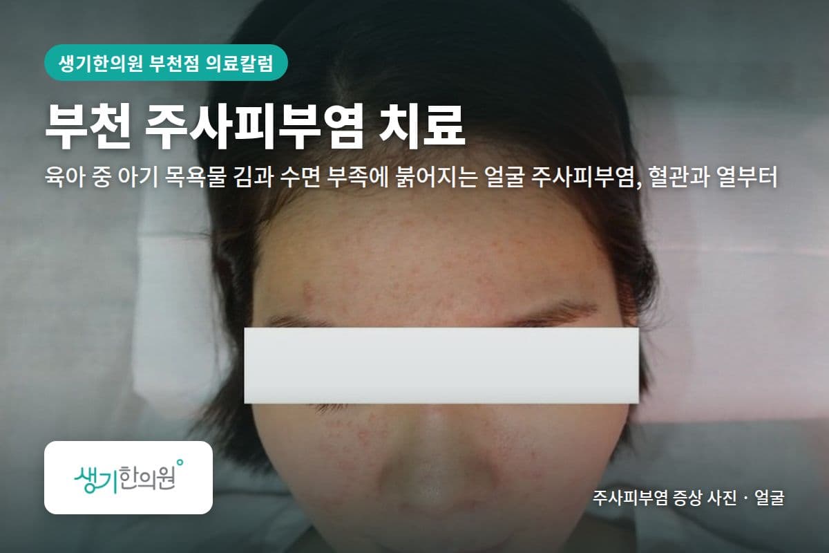 얼굴 주사피부염 증상 사진과 문구 「부천 주사피부염 치료, 육아 중 아기 목욕물 김과 수면 부족에 붉어지는 얼굴 주사피부염, 혈관과 열부터 · 생기한의원 부천점」