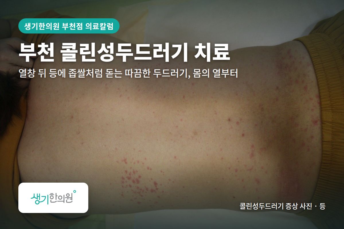 등 콜린성두드러기 증상 사진과 문구 「부천 콜린성두드러기 치료, 열창 뒤 등에 좁쌀처럼 돋는 따끔한 두드러기, 몸의 열부터 · 생기한의원 부천점」