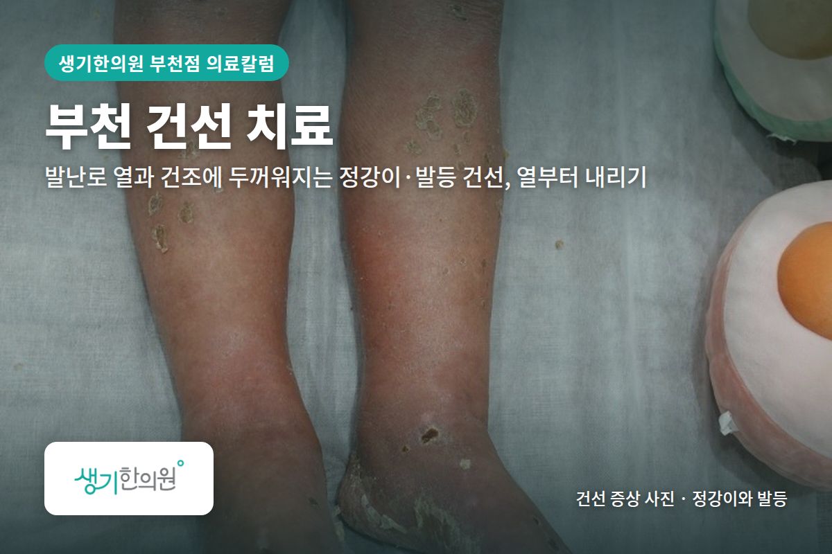 정강이와 발등 건선 증상 사진과 문구 「부천 건선 치료, 발난로 열과 건조에 두꺼워지는 정강이·발등 건선, 열부터 내리기 · 생기한의원 부천점」
